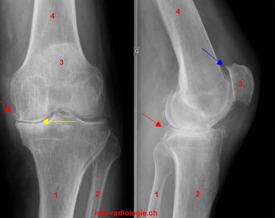 arthrose au genou