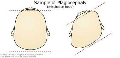 plagiocephaly1
